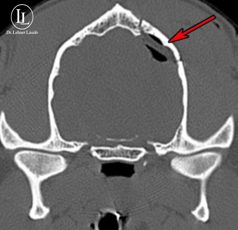 Postop CT